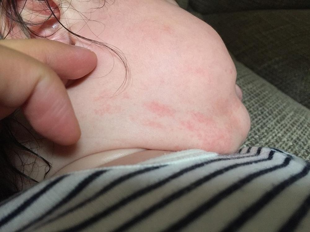 食物アレルギー