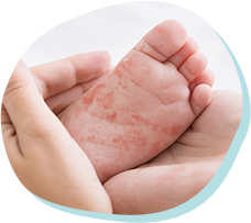 小児皮膚科