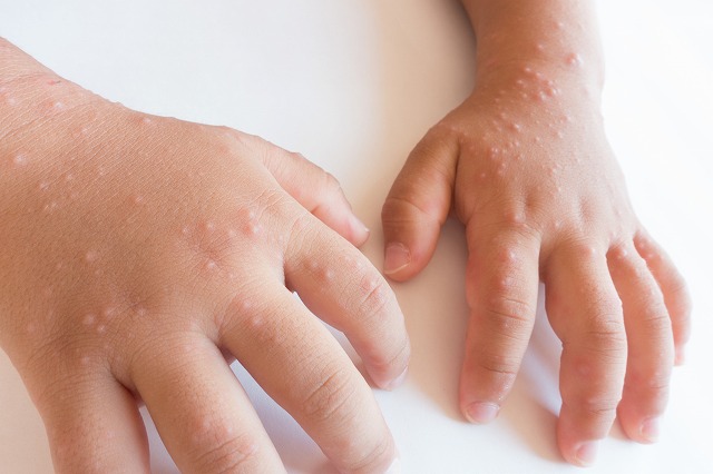 手足口病とは？